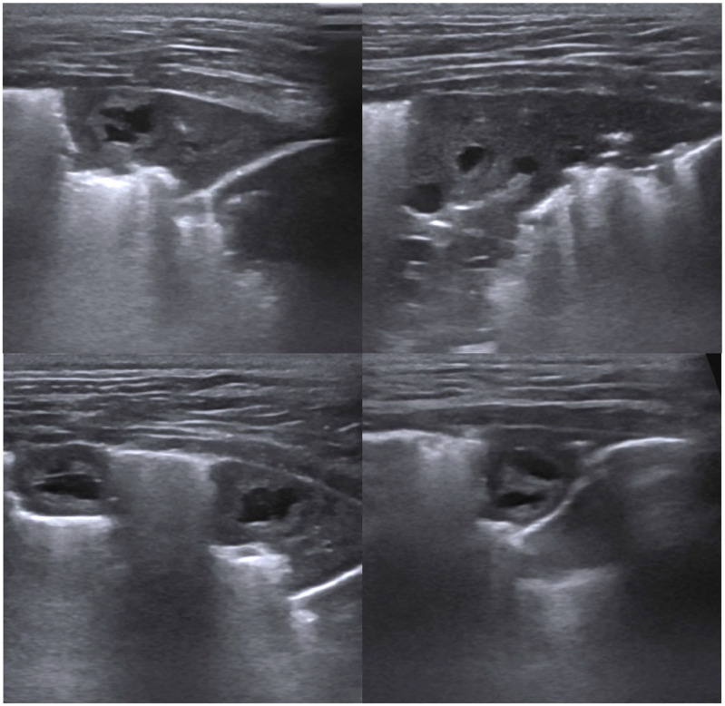Lung ultrasound findings and therapeutic outcome in a cat with recurrent spontaneous pneumothorax caused by paragonimiasis.