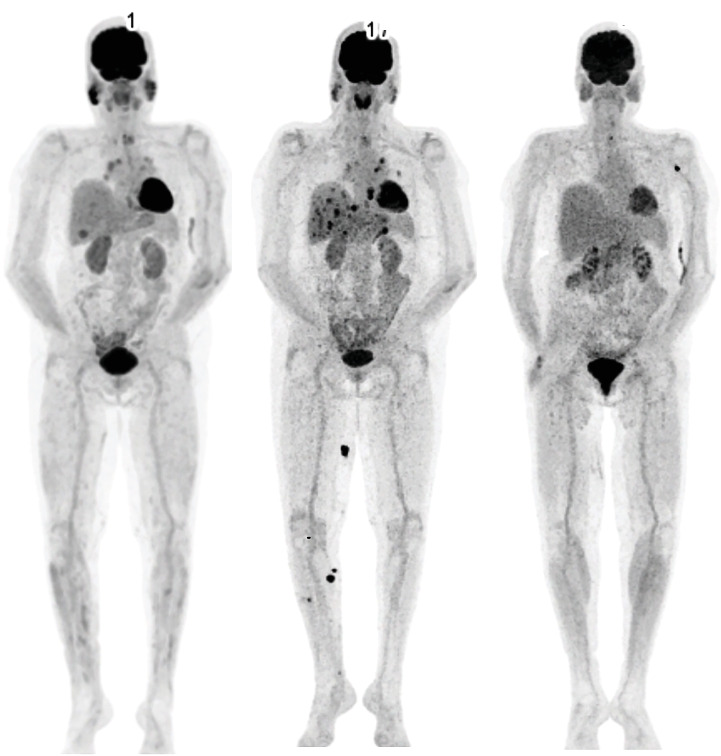 Hypercalcemia as an Immune-Related Adverse Event in a Patient Receiving Nivolumab and Ipilimumab for Metastatic Melanoma: A Case Report.