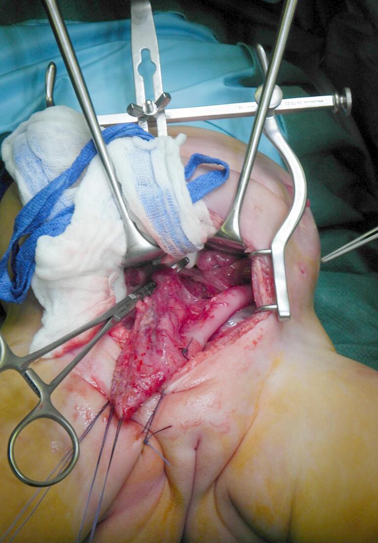 Colostomy complications in patients with anorectal malformations.