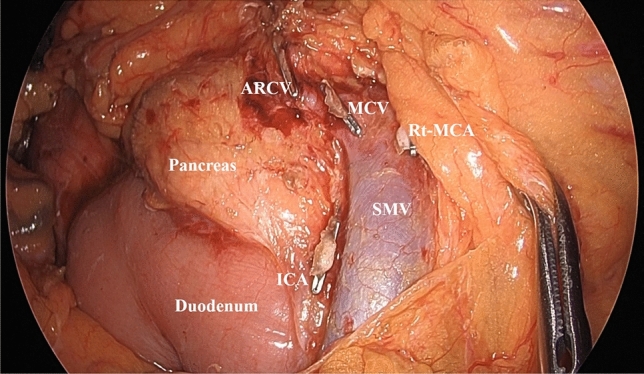 Inferior versus medial approach in laparoscopic and robotic surgery with complete mesocolic excision for right-sided colon cancer: propensity score-matched analysis.