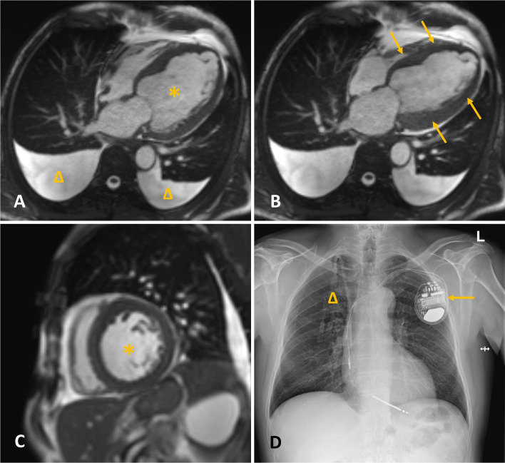 The application of paravertebral block for open cholecystectomy in a high-risk patient with an implantable cardioverter-defibrillator: a case report.