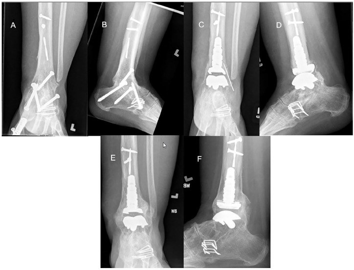 Midterm Outcomes Following Conversion of Failed Ankle Arthrodesis to Total Ankle Arthroplasty, Including Patients With a Deficient Fibula.