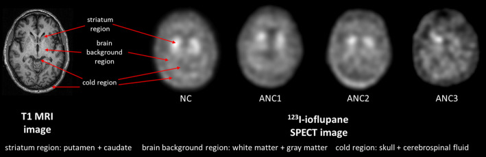 Development of a population of digital brain phantoms for radionuclide imaging research in Parkinson's disease.