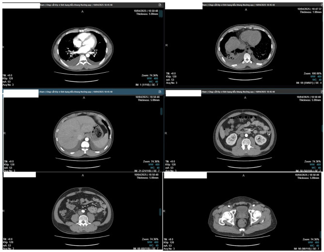 Drug-induced hypersensitivity reaction presenting as systemic capillary leak-like syndrome with polyserositis: a case report.