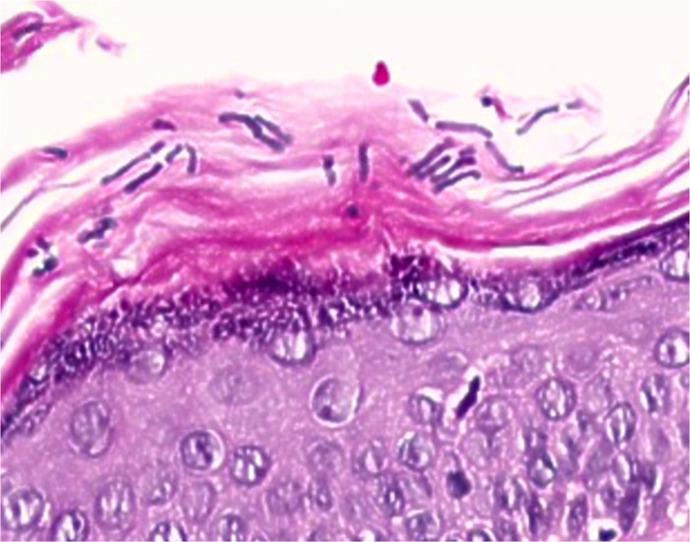 Kerion Celsi in Elderly Female, Caused by <i>Trichophyton rubrum</i>: Case Report.