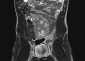 Pelvic Ectopic Kidney in an Adult: Robotic-Assisted Surgical Treatment of Unrecognized Ureteropelvic Junction Obstruction.