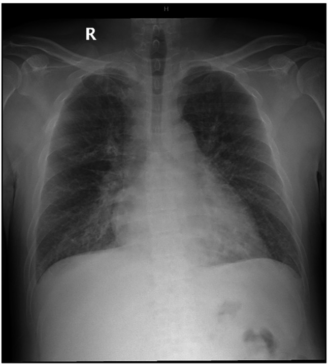 Drug-induced hypersensitivity reaction presenting as systemic capillary leak-like syndrome with polyserositis: a case report.