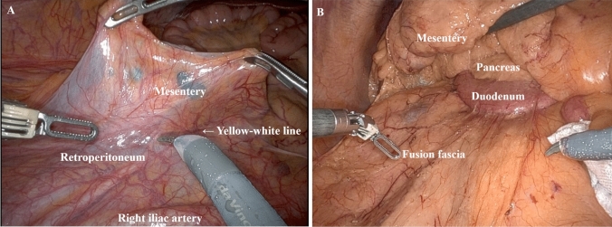 Inferior versus medial approach in laparoscopic and robotic surgery with complete mesocolic excision for right-sided colon cancer: propensity score-matched analysis.