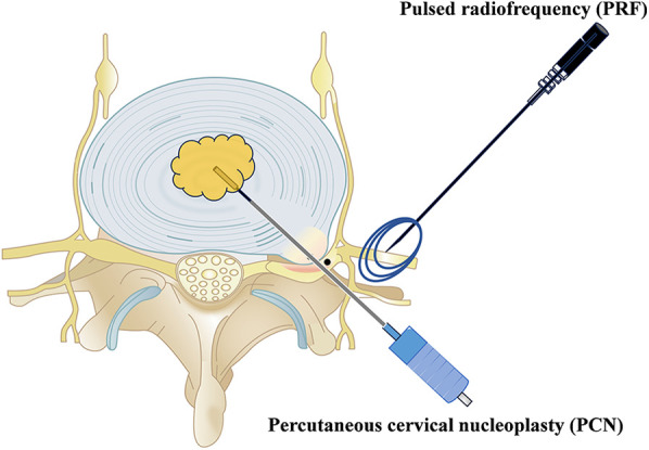 Clinical and radiological comparison of percutaneous cervical nucleoplasty combined with ultrasound-guided pulsed radiofrequency of cervical nerve root for cervical radicular pain: a retrospective, matched-cohort study.