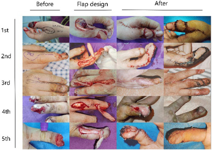 Skin pedicle expansion technique in dorsal nerve fascial Island flap: enhancing viability in repairing digital soft tissue defects.