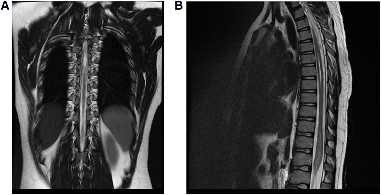 Acute Transverse Myelitis in a Child Following Oral Live Polio Vaccine Administration.
