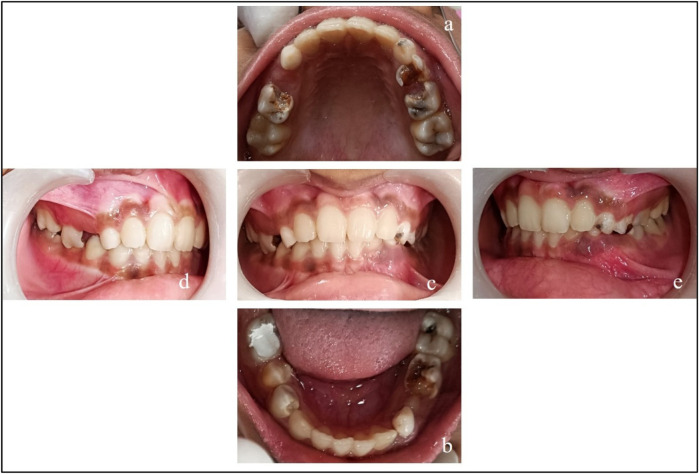 Pre-eruptive intracoronal resorption in a 10-year-old girl: a review and case report.
