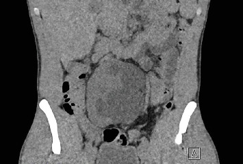 Pelvic Ectopic Kidney in an Adult: Robotic-Assisted Surgical Treatment of Unrecognized Ureteropelvic Junction Obstruction.