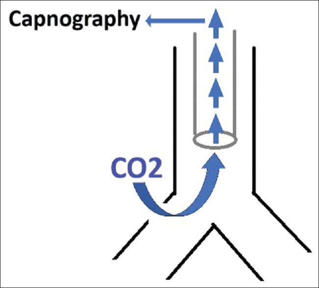 End-Tidal Carbon Dioxide - A Guided Tool to Diagnose a Bronchial Tree Injury in Thoracoscopic Procedures.