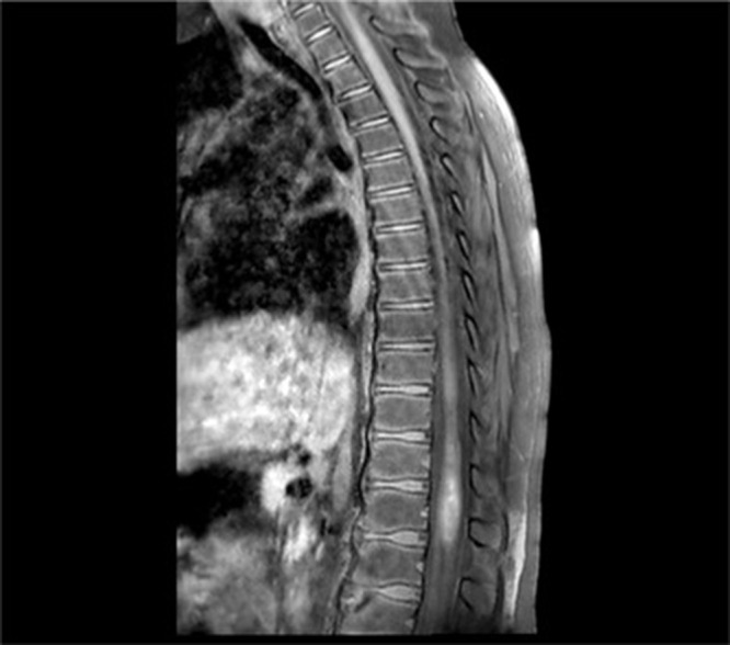 Acute Transverse Myelitis in a Child Following Oral Live Polio Vaccine Administration.