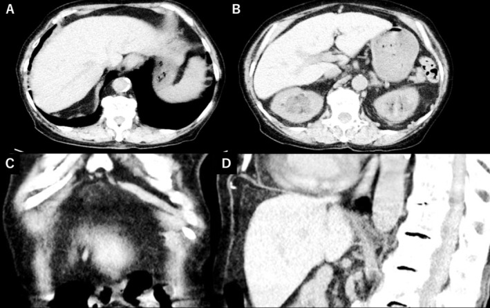 Nonsurgical Pneumoperitoneum: A Rare Thoracoabdominal Complication of Asthma Exacerbation.