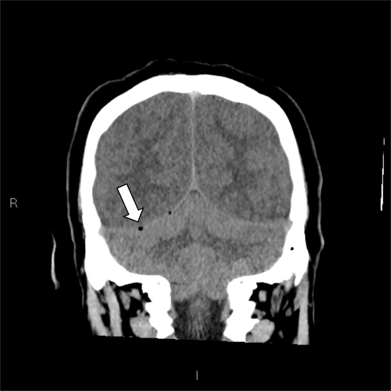 Catastrophic cerebral venous sinus thrombosis secondary to fulminant invasive otomastoiditis.