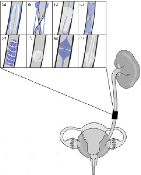 Ureteral Occlusion: Device Strategies, Approaches, and Results.