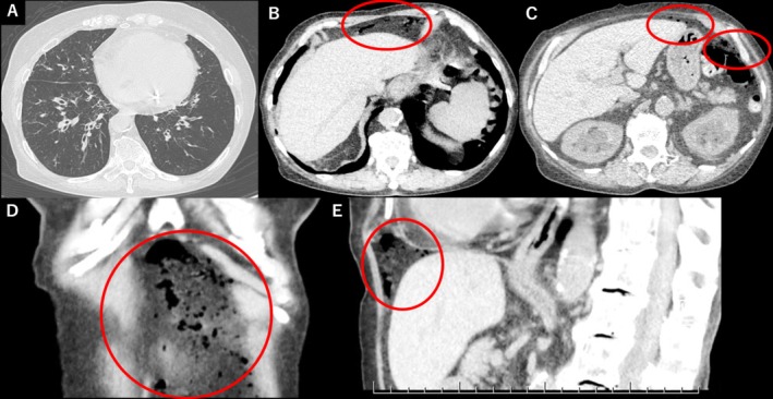 Nonsurgical Pneumoperitoneum: A Rare Thoracoabdominal Complication of Asthma Exacerbation.