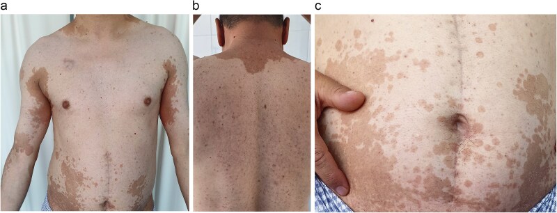When Pityriasis Versicolor wears a vitiligo mask: a puzzle in an immunocompromised patient.