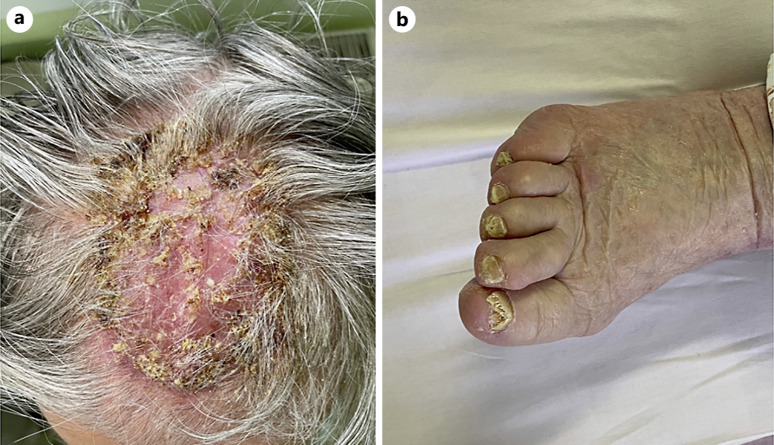 Kerion Celsi in Elderly Female, Caused by <i>Trichophyton rubrum</i>: Case Report.