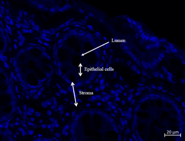 Colorectal cancer biofilm composition reveals distinct bacterial species signature