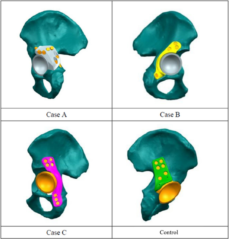 Custom 3D-printed porous titanium augments for Paprosky type III acetabular defects: a case series combining biomechanical rationale with early clinical outcomes.