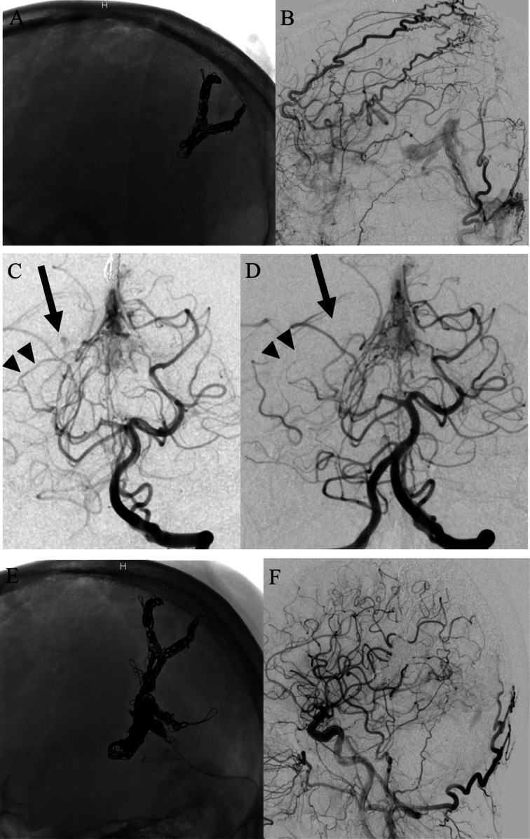 A case of intracranial hemorrhage due to rupture of aneurysm of the distal posterior cerebral artery associated with dural arteriovenous fistulas of the falcine sinus.