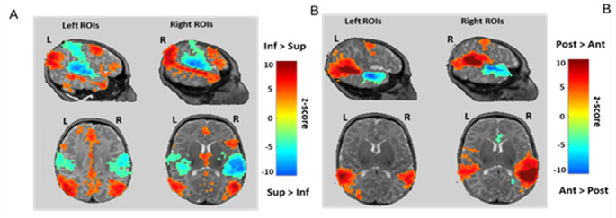 Functional connectivity of the superior temporal sulcus at term-equivalent age: effects of gestational age and sex.