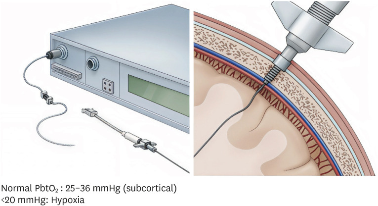 Brain Oxygenation and Metabolism Monitoring in Acute Brain Injury: Review on Current Trends and Clinical Implications.
