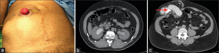 Volvulus of segment of ileal conduit anterior to the rectus sheath presenting as acute urinary retention.