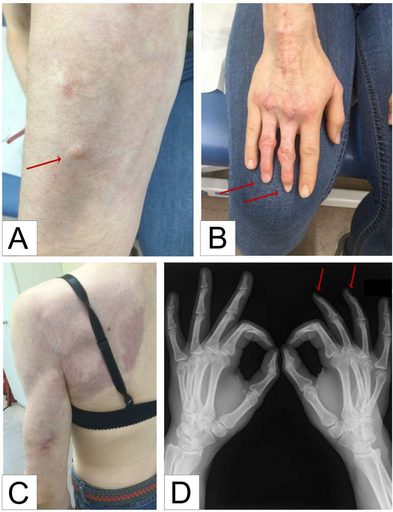 Infantile myofibromatosis and capillary malformation of the skin due to PDGFRB mosaicism.