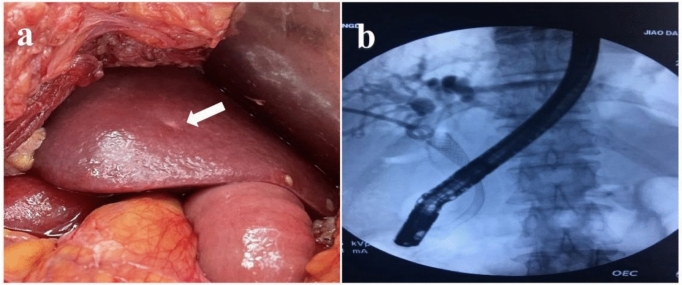 Conversion therapy and R0 resection for pancreatic cancer with multiple liver metastases: a case report.