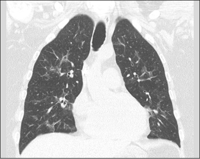 Computed tomography findings of pneumonia resistant to empirical therapy in patients with hematologic diseases.