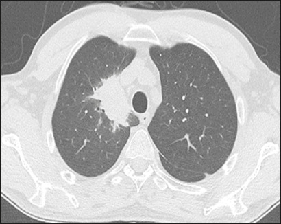 Computed tomography findings of pneumonia resistant to empirical therapy in patients with hematologic diseases.