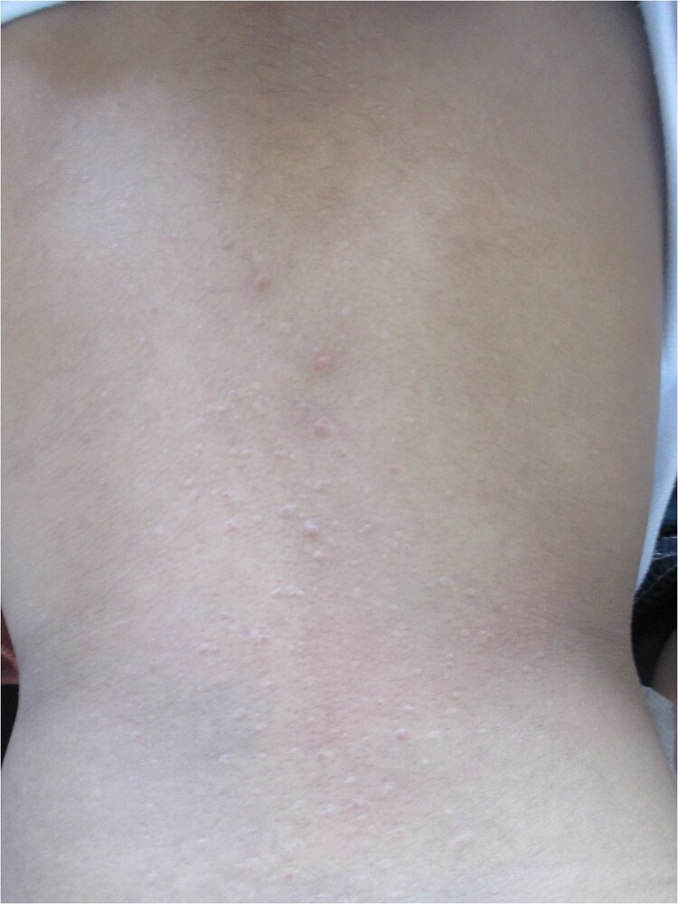 Langerhans cell histiocytosis disguised as lichenoid eruption.