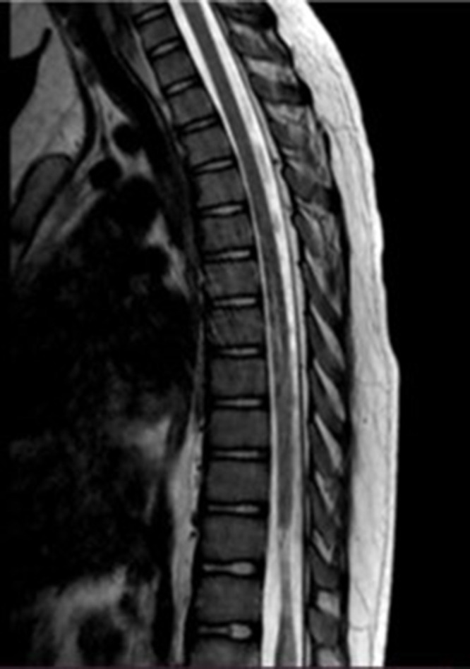 Acute Transverse Myelitis in a Child Following Oral Live Polio Vaccine Administration.