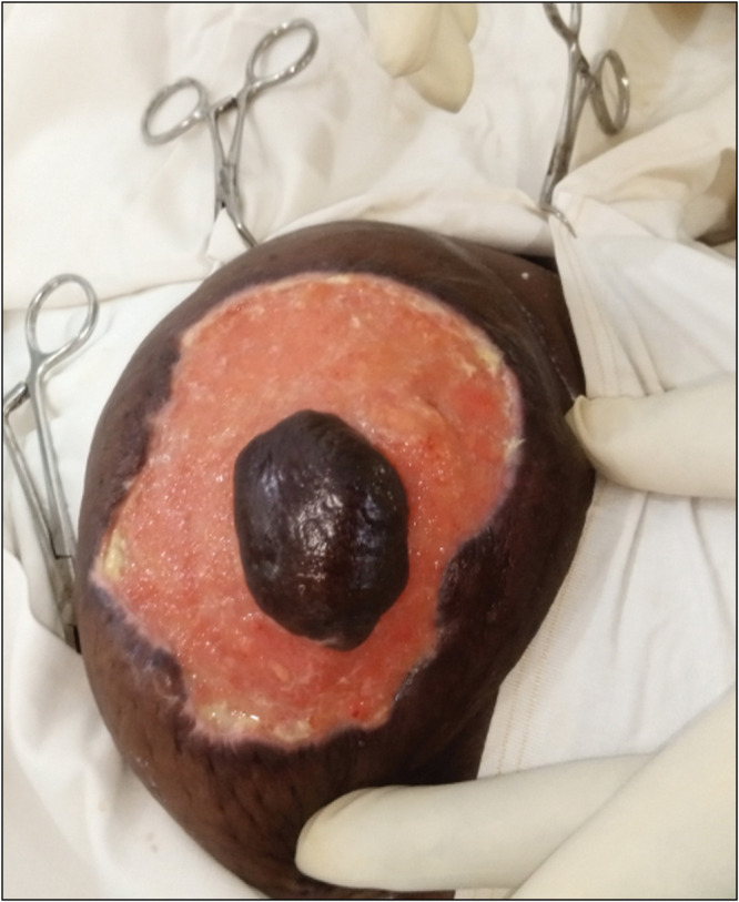 Primary Breast Necrotising Fasciitis in an Elderly Woman Managed with Nipple-Areola Conservation and Delayed Primary Closure in a Resource-Poor Setting A Case Report.