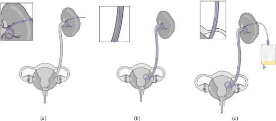 Ureteral Occlusion: Device Strategies, Approaches, and Results.