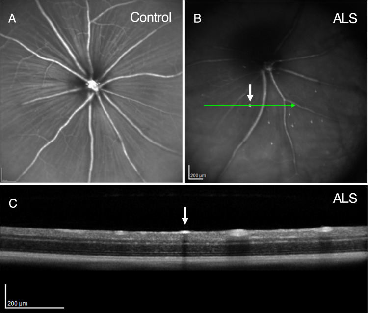 A Novel Retinal Nerve Fiber Layer Biomarker of Amyotrophic Lateral Sclerosis (ALS) Identified Using Longitudinal in vivo Ocular Imaging.