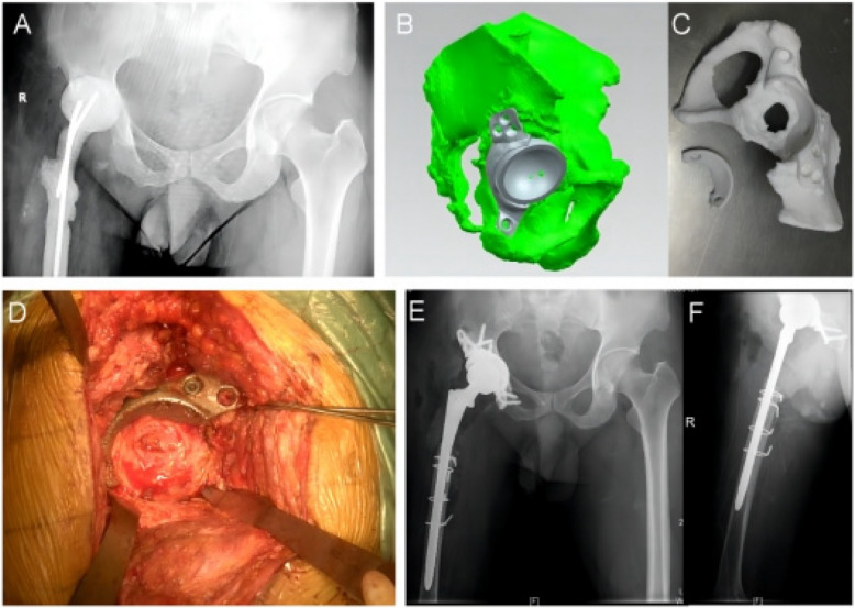 Custom 3D-printed porous titanium augments for Paprosky type III acetabular defects: a case series combining biomechanical rationale with early clinical outcomes.