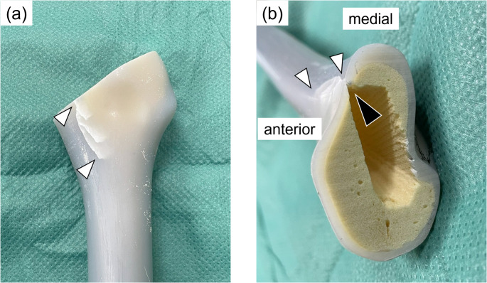 Biomechanical comparison of cemented versus cementless fixation in intraoperative femoral fractures during total hip arthroplasty.