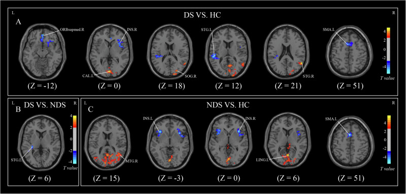 Left amygdala alterations mediate the effects of negative symptoms on social dysfunction in schizophrenia.