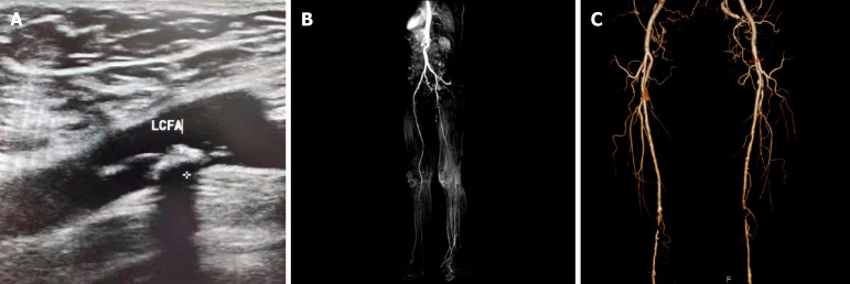 Comparison of three diagnostic imaging modalities for use in diabetic inferior arterial lesions.