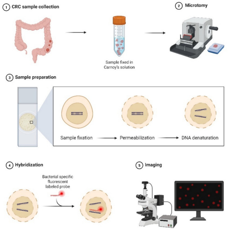 Colorectal cancer biofilm composition reveals distinct bacterial species signature