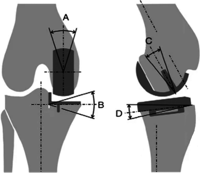 The association between surgeon grade and radiographic implant alignment following oxford unicompartmental knee replacement.