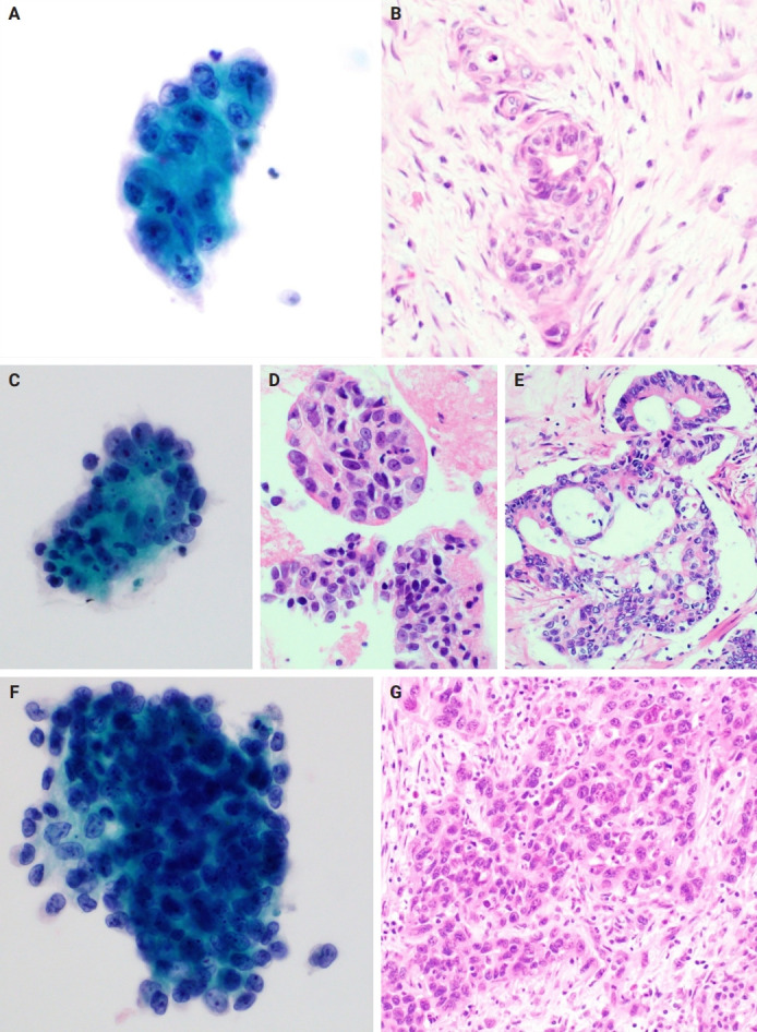 Pancreatic cancer in liquid-based cytology: cytological features and cell block utility from 254 fine-needle aspiration samples.