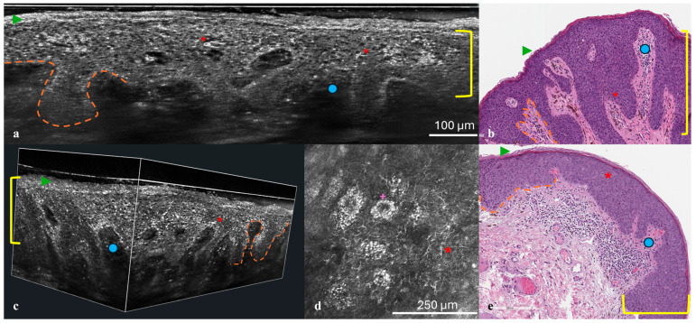 Non-Invasive Diagnostic Techniques in Penile Intraepithelial Neoplasia (PeIN): Insights from Reflectance Confocal Microscopy (RCM), Line-Field Confocal Optical Coherence Tomography (LC-OCT), and Correlation with Histopathological Features.