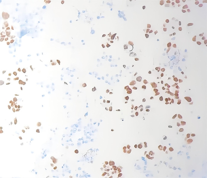 Integrated Traditional Chinese and Western Medicine in Lung Adenocarcinoma with Rare EGFR Mutation and Nephrotic Syndrome: A Case Report.