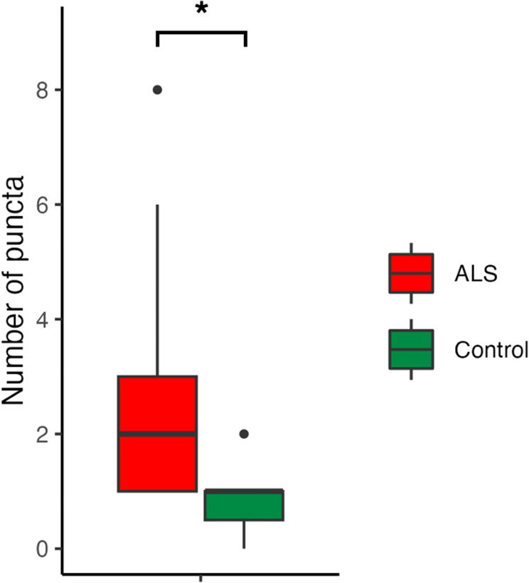 A Novel Retinal Nerve Fiber Layer Biomarker of Amyotrophic Lateral Sclerosis (ALS) Identified Using Longitudinal in vivo Ocular Imaging.
